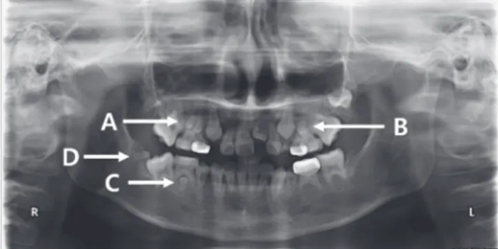 Fig. 2. The patient is 7 years old. Note, delayed formation  of the maxillary first premolars (A), taurodontism on the  mandibular primary molars (B), and missing teeth on the  mandibular premolars (C).