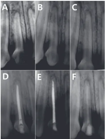 Fig. 1. Radiographs of the same tooth taken preoperatively  and immediately after filling with each materials