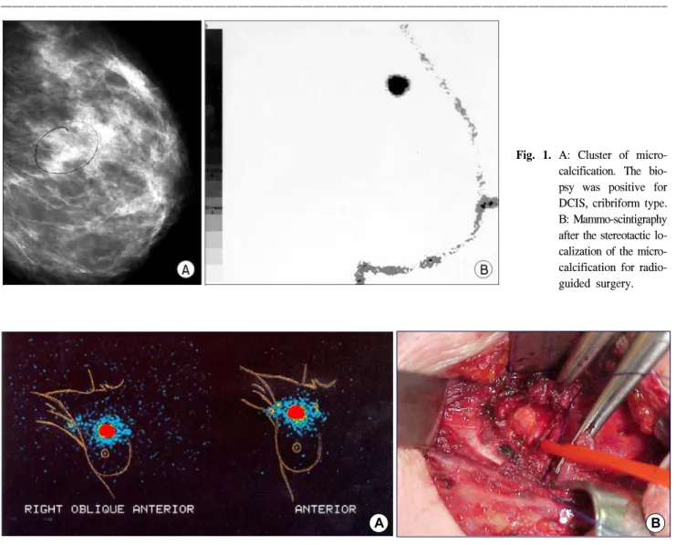 Fig.  1.  A:  Cluster  of  micro- micro-calcification.  The   bio-psy  was  positive  for  DCIS,  cribriform  type