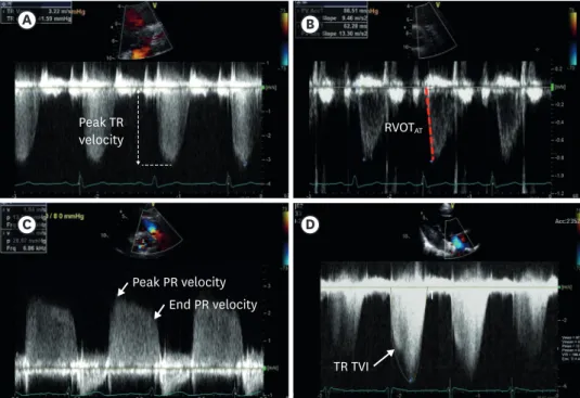 Figure 1. Echocardiographic images of methods for estimating mPAP. Estimation of mPAP using peak TR velocity  (A); RVOT AT  (B); peak and end PR velocity (C); and TR velocity TVI (D)