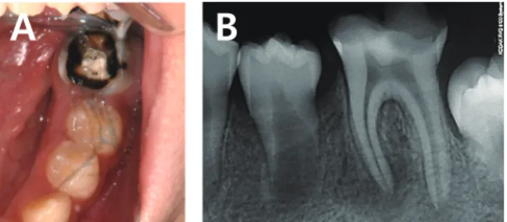 Fig. 1. (A) Clinical aspect of the left mandibular first molar  in a 9-year-old male patient shows extensive loss of coronal  dental tissue, (B) Initial radiographic aspect shows the  cav-ity nearing the pulp.