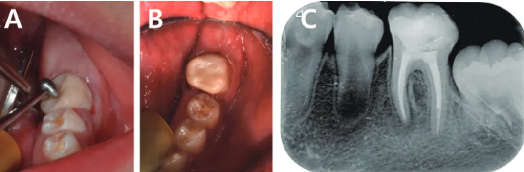 Fig. 4. (A) Conventional adhesive system is used to bond the endocrown to the prepared tooth, (B) Occlusal view after final  cementation, (C) Radiographic image after cementation and polishing.