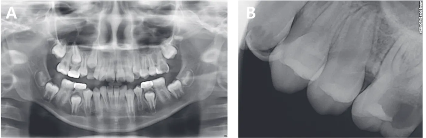 Fig. 6. (A) Initial panoramic radiograph of the left maxillary first molar (#26) in a 9-year-old female patient, (B)  Periapical radiograph of the tooth, #26, with severe loss of distal coronal tissue.