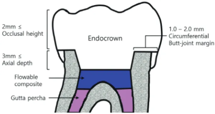 Fig. 9. Schematic drawing of the tooth preparation for the  endocrown restoration. Flowable composite resin could be  applied for blocking undercuts.
