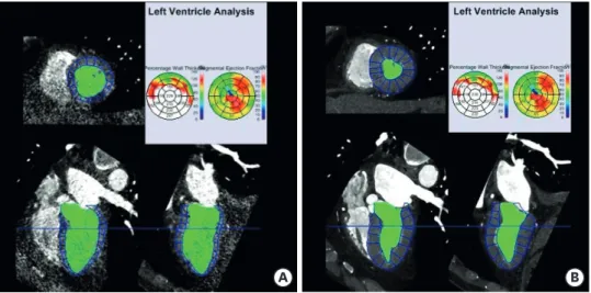 Figure 1. CT images of a 71-year-old male patient in end diastole (A) and end systole (B), which were obtained  to assess left ventricular function