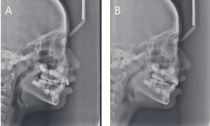 Fig. 2. Lateral cephalograms before (A) and after (B) treat- treat-ment in case 1.