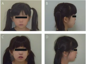 Fig. 5. Lateral cephalograms before (A) and after (B) treat- treat-ment in case 2.