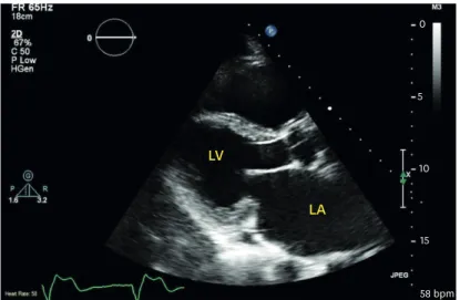 Figure 1. Transthoracic echocardiogram in para-sternal long axis showing coaptation deficit of the mitral valve