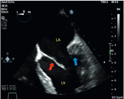 Figure 2. Transesophageal echocardiography mid-esophageal view, 0°, showing the mitral valve with a  rudimental posterior mitral leaflet adherent to the LV posterior wall (blue arrowhead) and elongated anterior  mitral leaflet (red arrowhead)