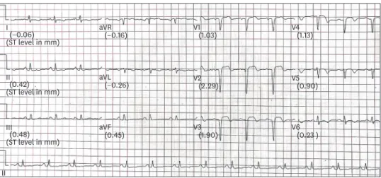 Figure 1. Electrocardiogram shows QS complexes in V1-V4 with persistent ST segment elevation and T wave  inversion in precordial leads.
