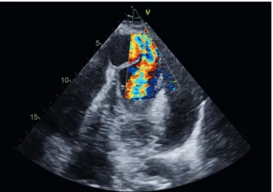 Figure 3. Modified apical 4 chambered view with colour Doppler demonstrating bidirectional shunt.