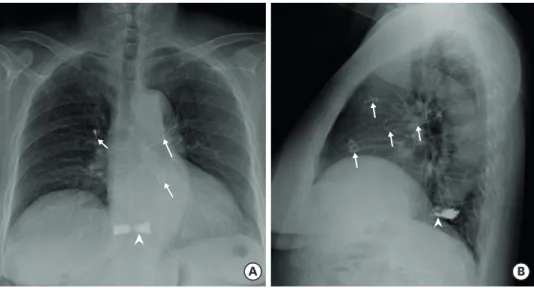Figure 1. Simple X-ray images of chest PA (A) and chest left-lateral (B) show a round radio-opaque mass made  of coiled lines in the pulmonary artery and linear materials in the left and right pulmonary artery (arrow)