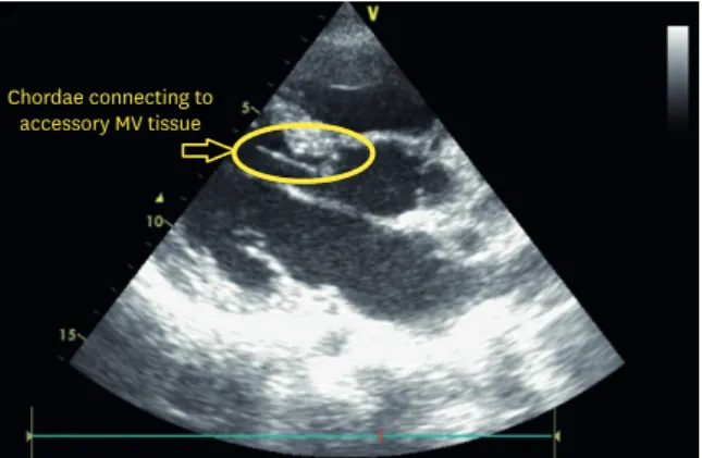 Figure 2. Parasternal long-axis view showing accessory mitral valve tissue attached to the chordae.