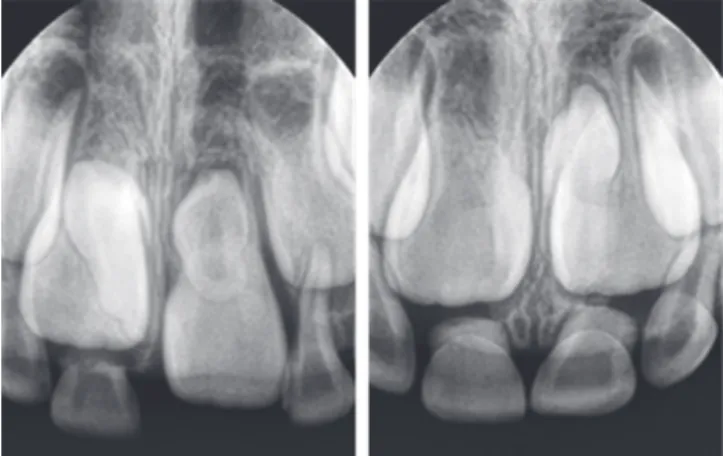Fig. 1. Periapical radiograph of impacted supernumerary  tooth. 