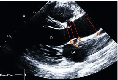 Figure 1. Measurements of aortic root size at 4 different levels using 2-dimensional transthoracic 