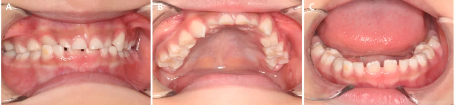 Fig. 2. Intraoral view of the 1st case. At the age of 6 years, both maxillary permanent canines are fully erupted and the right  permanent canine formed a crossbite with the mandibular primary canine (A-C).