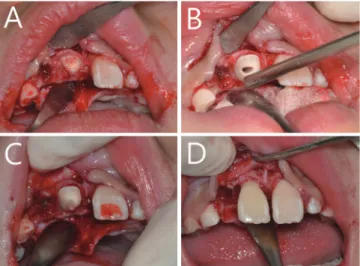Fig. 4. The reattachment procedure. (A) Flaps were elevated  and  the  root  portion  was  exposed