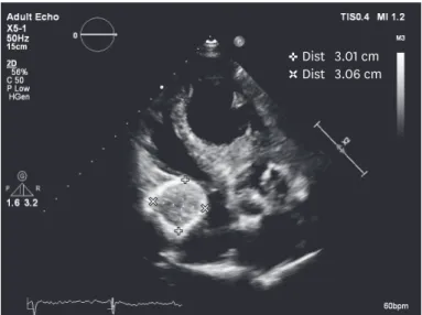Figure 1. Echocardiogram still image showing calcified and rounded right atrial mass.