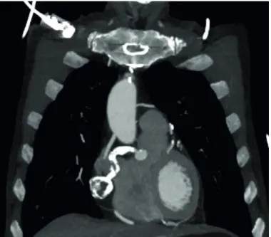 Figure 2. CT angiogram showing coronal images of the heavily calcified and thrombosed right coronary aneurysm.