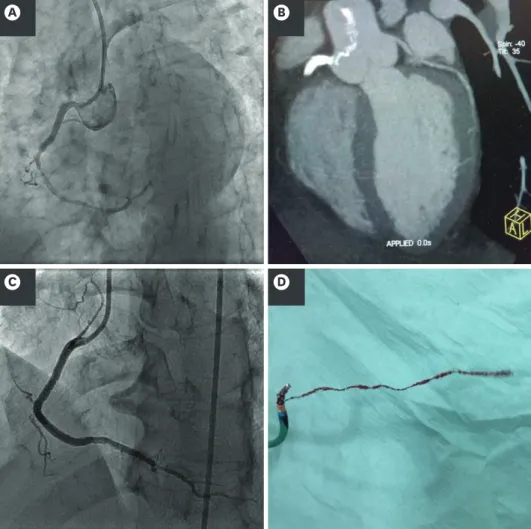 Figure 1. Coronary images by conventional angiogram and by CT images. (A) Coronary angiography showing stent  in right coronary artery (RCA) with lesion distal to stent