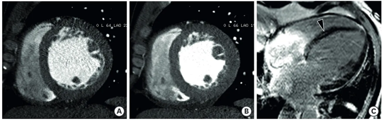 Figure 12. Dilated cardiomyopathy in a 63-year-old male. Short-axis multiplanar reformatted images of arterial-phase cardiac computed tomography obtained  during end-diastole (A) and end-systole (B) show a dilated left ventricle (LV), preserved myocardial 
