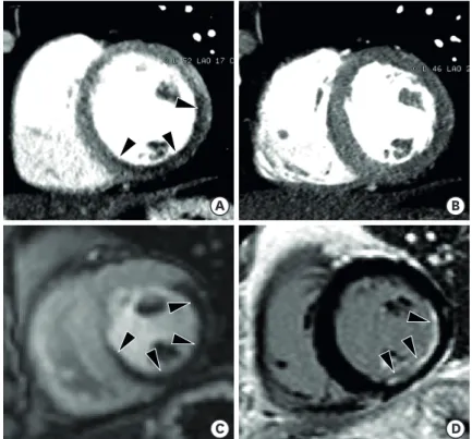 Figure 2. Static stress perfusion cardiac computed tomography (CT) imaging in a 40-year-old male with chest  discomfort