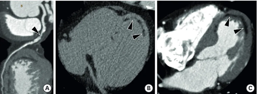 Figure 5. Left ventricular (LV) myocardial fat with cardiac computed tomography (CT) in a 51-year-old male with  old myocardial infarction