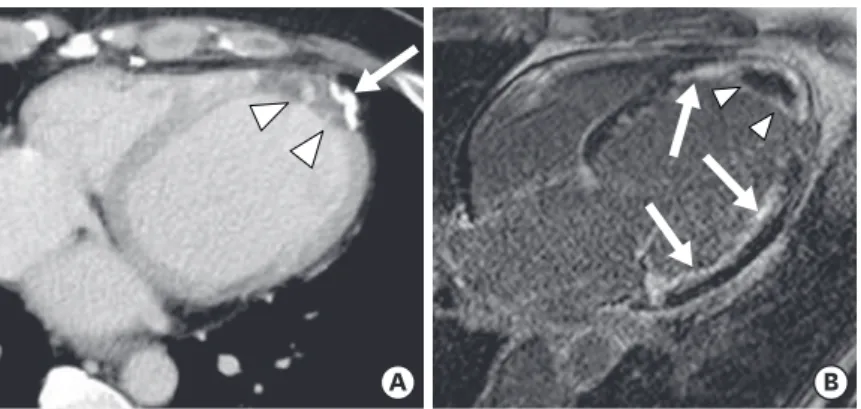 Figure 6. Left ventricular (LV) aneurysm with calcification and intracavitary thrombus in a 65-year-old male with  old myocardial infarction (MI)