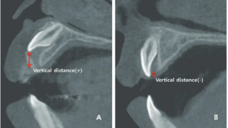 Fig. 1. Vertical distance in sagittal view. (A) Positive value  when impacted in alveolar bone, (B) negative value when  partially erupted.