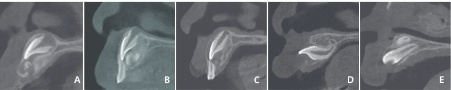 Fig. 4. Gender and age distribution of patients with im- im-pacted permanent maxillary incisors.