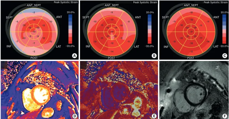 Figure 1. (A) Global longitudinal strain (GLS) at initial presentation (-8.3%). (B) GLS after 3 months of heart failure management (-13.0%)