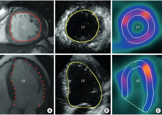 Figure 1. Examples of short-axis (top) and long axis (bottom) cut planes with endocardial tracings in images  acquired by CMR (A), 3DE (B) and SPECT (C) demonstrating the difference in the ability to identify LV 