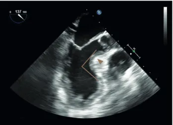 Figure 1. Mid-esophageal long axis view shows severe focal hypertrophy of the ventricular septum (arrow head)  with an 82° angulation between the basal portion of the ventricular septum and the ascending aorta (line), as  well as an accessory calcified pap