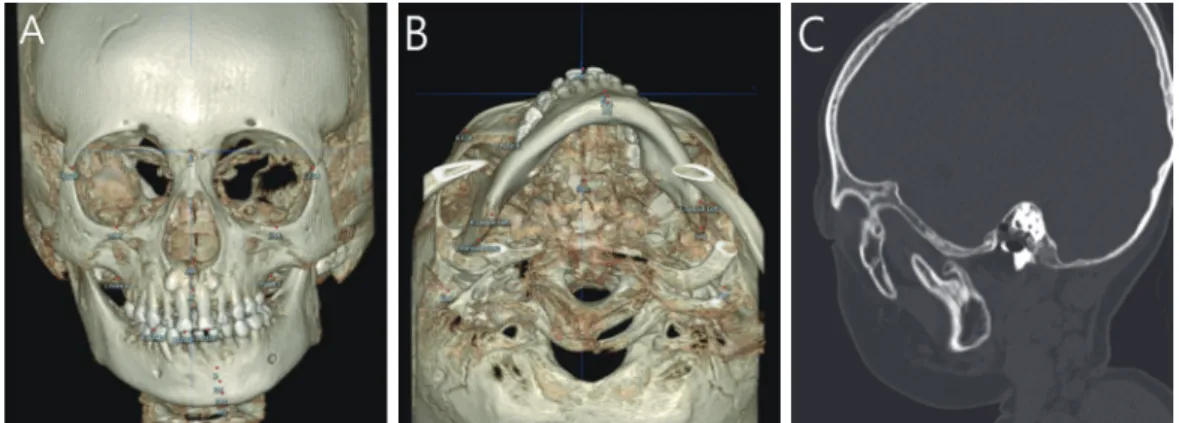 Fig. 2. Initial CBCT view. (A) Mandibular displacement observed in frontal view. (B) Mandibular displacement observed in axial  view