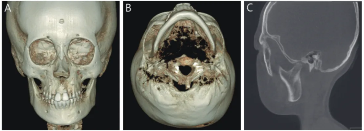 Fig. 4. CBCT view after 6 years. (A) Mandibular displacement is descreased in frontal view