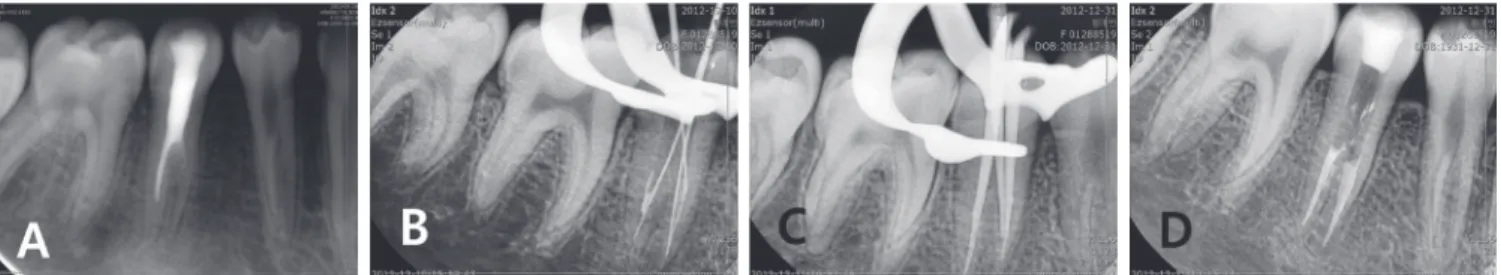 Fig. 5. Endodontic treatment procedures of mandibular right second premolar. (A) Initial periapical view, (B) Working length  determination, (C) Master cone adaption, (D) Filling of three canals.
