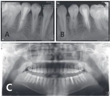 Fig. 6. Endodontic treatment procedures of mandibular left second premolar. (A) Initial periapical view, (B) Working length  determination, (C) Master cone adaption, (D) Filling of three canals.