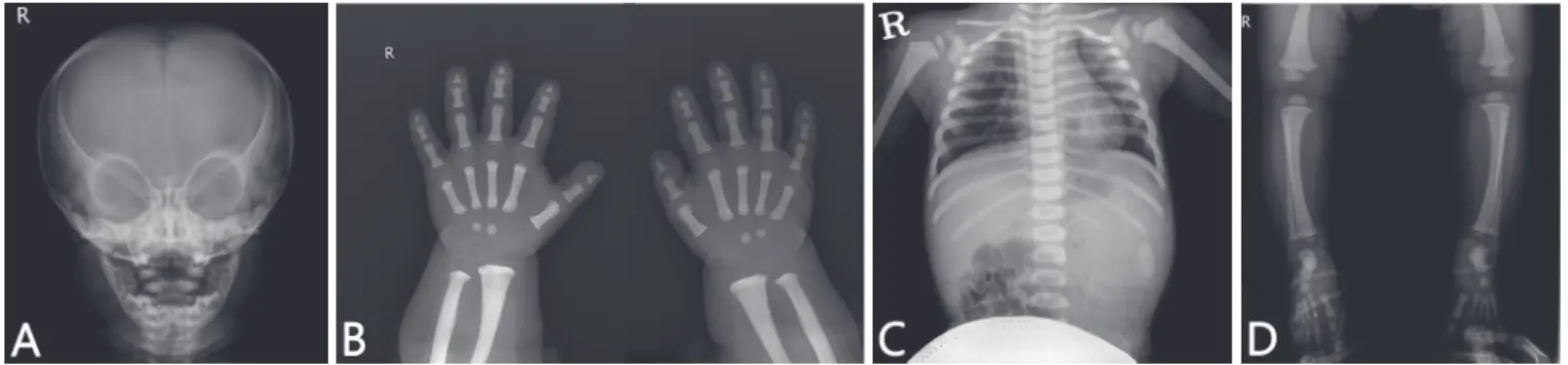 Fig. 1. Osteosclerosis of the complete skeleton at 12 months of age (A-D). 
