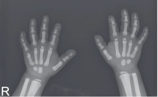 Fig. 3. Panoramic radiograph of the patient at the age of 4. 