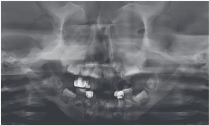 Fig. 5. Panoramic radiograph of the patient at the age of 5. 