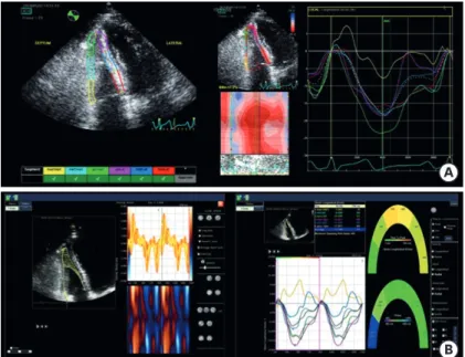 Figure 2. Demonstration of right ventricular strain measurement by GE EchoPAC software (A) and velocity vector  imaging (B).