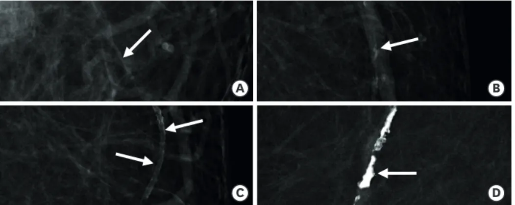 Figure 1. Scoring system of breast arterial calcification (BAC) density. The calcification density of the vessel in the  densest segment is scored using 4-step scale