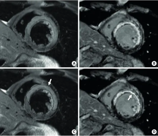 Figure 2. Example CMR images of anterior STEMI underwent PCI. Short-axis slices of T2-weighted image (A) and  the corresponding delayed hyperenhancement image (B) in patients with anterior STEMI