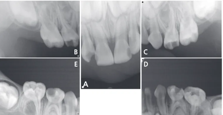 Fig. 1. Pre-operative periapical radiographs.