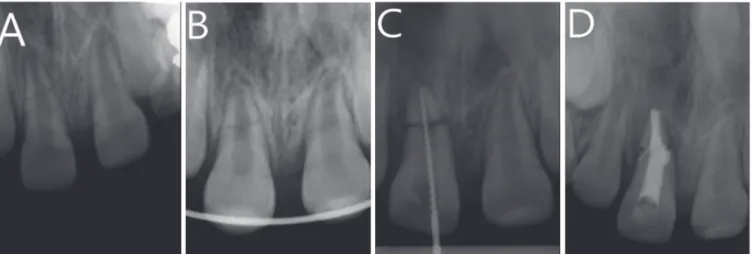 Fig. 1. Periapical radiographs of a root fracture. (A) Initial periapical view. (B) Reduction and wire-splinted root-fractured  tooth