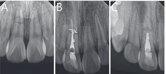 Fig. 7. Periapical radiographs of root fracture. (A) Initial periapical view. (B) Pulp extirpation and calcium hydroxide canal fill- fill-ing were performed