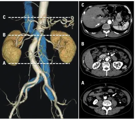 Fig. 3. Pre-operative computed tomography images indicating the left-sided inferior vena cava (IVC) (left: reconstructed 3-dimensional image, right: 