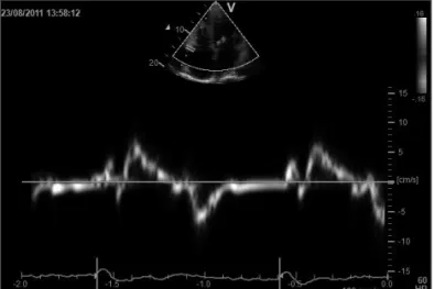 Fig. 2. Tissue Doppler imaging of the right ventricle with pulsed  Doppler sample volume placed in the tricuspid annulus in a patient with  end-stage left ventricular heart failure