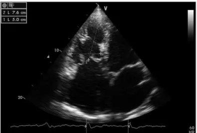 Fig. 4. Right ventricular sphericity index in a patient with end-stage left  ventricular heart failure (0.66)
