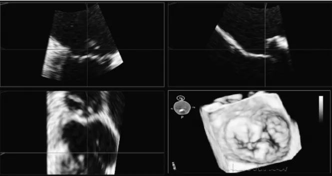 Fig. 1. Screenshot of the Mitral-Valve-Quantification software showing the volume-rendered 3D data set (bottom right) as well as the three cut planes  used to improve the visualization of the mitral valve
